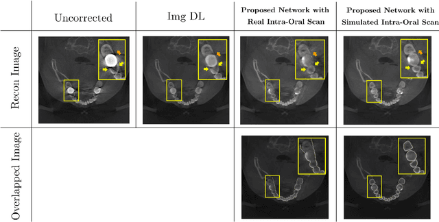Figure 3 for Metal Artifact Reduction with Intra-Oral Scan Data for 3D Low Dose Maxillofacial CBCT Modeling