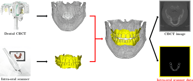 Figure 4 for Metal Artifact Reduction with Intra-Oral Scan Data for 3D Low Dose Maxillofacial CBCT Modeling