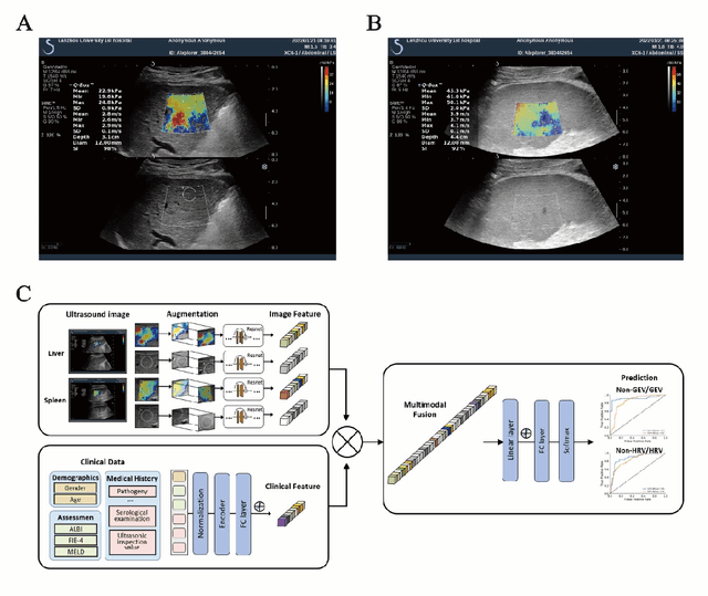 Figure 3 for Deep learning radiomics for assessment of gastroesophageal varices in people with compensated advanced chronic liver disease