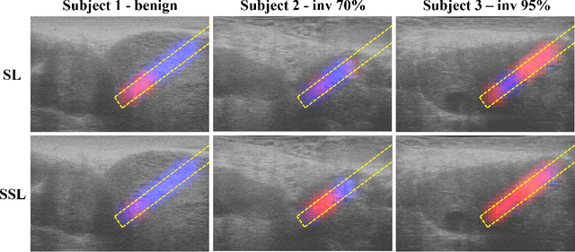 Figure 3 for Self-Supervised Learning with Limited Labeled Data for Prostate Cancer Detection in High Frequency Ultrasound