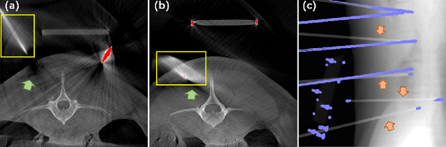 Figure 1 for PDS-MAR: a fine-grained Projection-Domain Segmentation-based Metal Artifact Reduction method for intraoperative CBCT images with guidewires