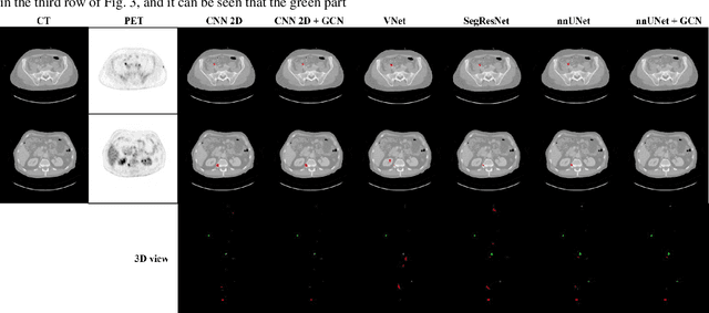 Figure 4 for 3D PETCT Tumor Lesion Segmentation via GCN Refinement
