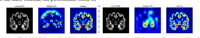 Figure 3 for Attention-based 3D CNN with Multi-layer Features for Alzheimer's Disease Diagnosis using Brain Images