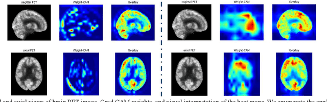 Figure 4 for Attention-based 3D CNN with Multi-layer Features for Alzheimer's Disease Diagnosis using Brain Images