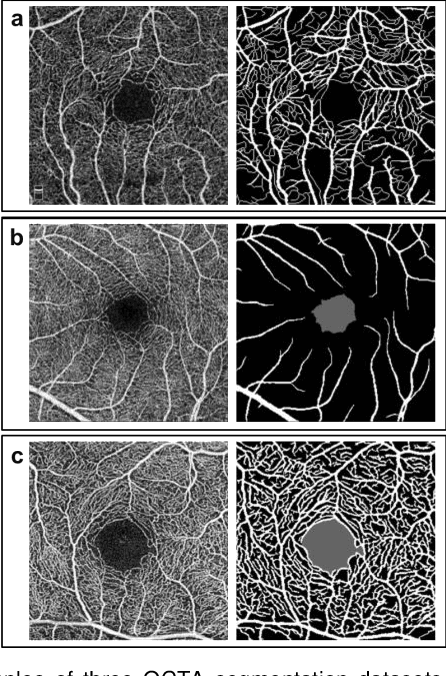 Figure 3 for OMSN and FAROS: OCTA Microstructure Segmentation Network and Fully Annotated Retinal OCTA Segmentation Dataset