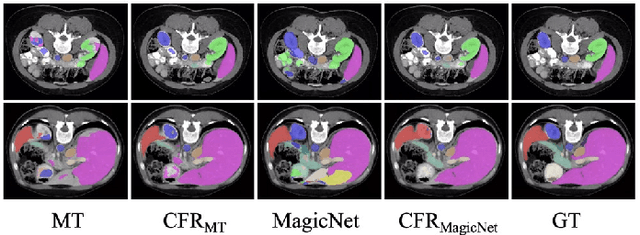 Figure 3 for Concatenate, Fine-tuning, Re-training: A SAM-enabled Framework for Semi-supervised 3D Medical Image Segmentation