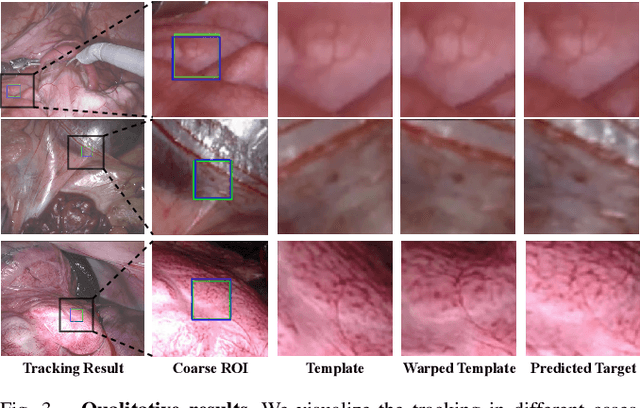 Figure 3 for Ada-Tracker: Soft Tissue Tracking via Inter-Frame and Adaptive-Template Matching
