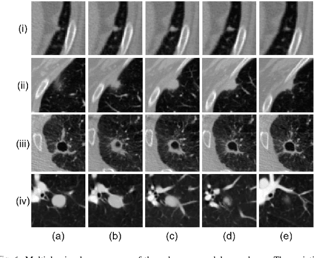Figure 1 for MESAHA-Net: Multi-Encoders based Self-Adaptive Hard Attention Network with Maximum Intensity Projections for Lung Nodule Segmentation in CT Scan