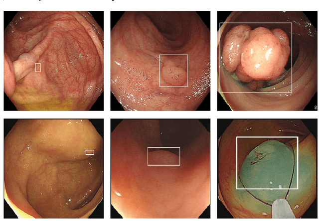 Figure 1 for YOLO-OB: An improved anchor-free real-time multiscale colon polyp detector in colonoscopy