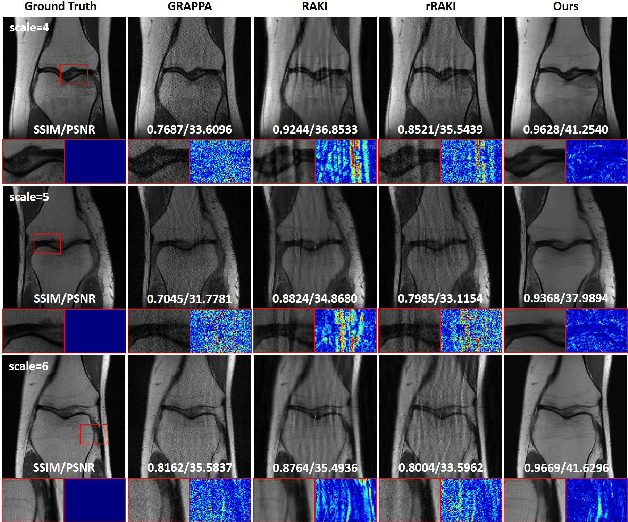 Figure 4 for Batch Implicit Neural Representation for MRI Parallel Reconstruction