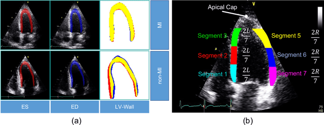 Figure 3 for Ensemble Learning of Myocardial Displacements for Myocardial Infarction Detection in Echocardiography