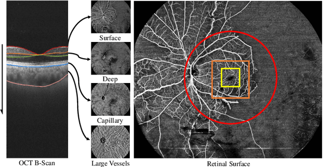 Figure 1 for Leveraging Multimodal Fusion for Enhanced Diagnosis of Multiple Retinal Diseases in Ultra-wide OCTA