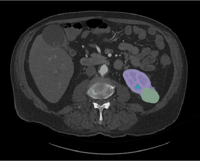 Figure 1 for The KiTS21 Challenge: Automatic segmentation of kidneys, renal tumors, and renal cysts in corticomedullary-phase CT
