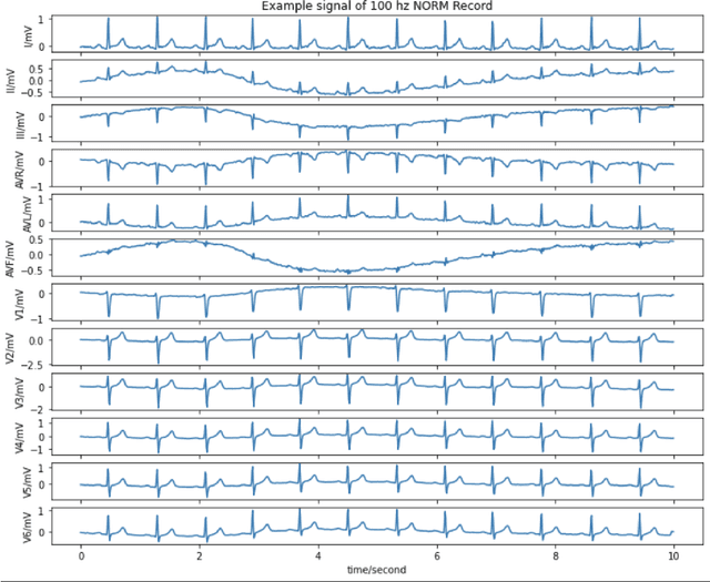 Figure 1 for MVMTnet: A Multi-variate Multi-modal Transformer for Multi-class Classification of Cardiac Irregularities Using ECG Waveforms and Clinical Notes