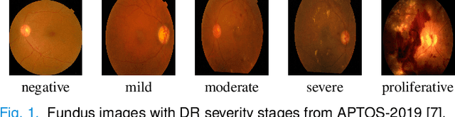 Figure 1 for Detecting Severity of Diabetic Retinopathy from Fundus Images using Ensembled Transformers