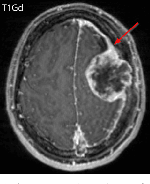 Figure 3 for The ASNR-MICCAI Brain Tumor Segmentation (BraTS) Challenge 2023: Intracranial Meningioma